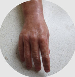 Hand cosmetic prosthesis - myo-electric - Northern Prosthetics - adult