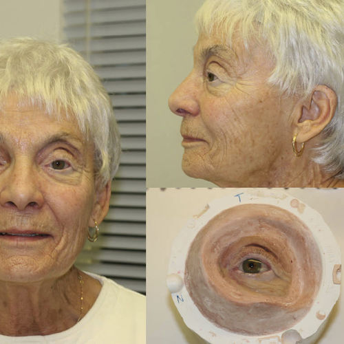 Orbital cosmetic prosthesis - Prosthetic Artists - adult