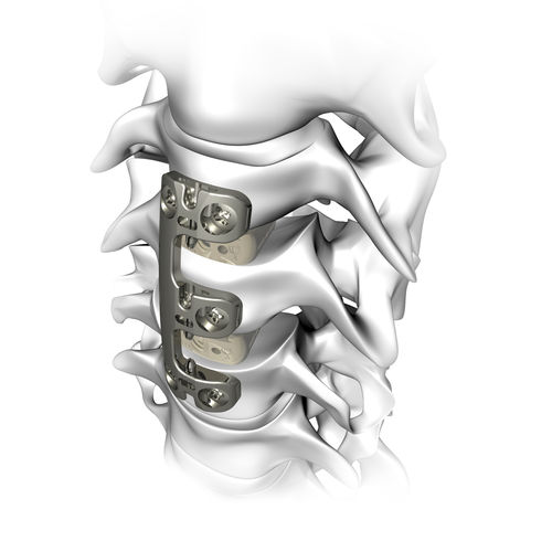 Cervical arthrodesis plate - VERTEVIEW - Atlas Spine - locking ...