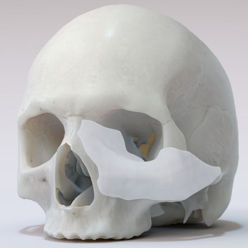 Custom-made periorbital implant - TnR PSI - T&R Biofab - absorbable