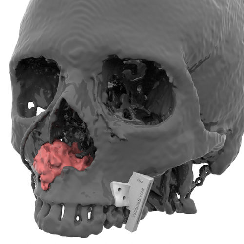 Maxillofacial reconstruction resection guide - Kune Implants