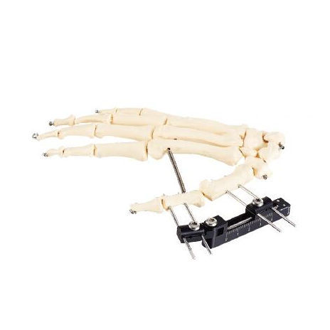 Metacarpophalangeal joint external fixation system - Wuhan Yijiabao Biological Materials - tubular / adult