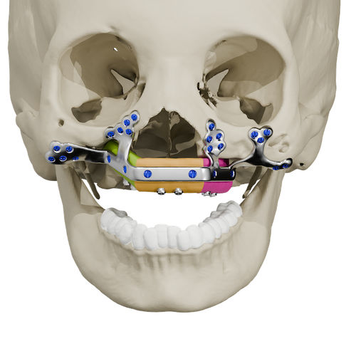 Custom-made maxillar implant - Craniotech