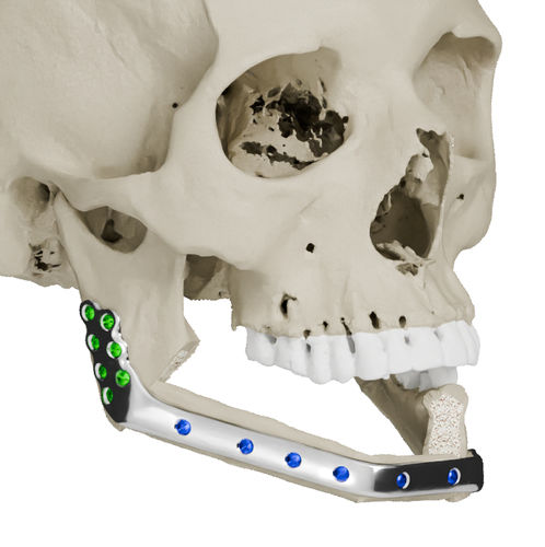 Custom-made mandibular implant - Craniotech - non-absorbable