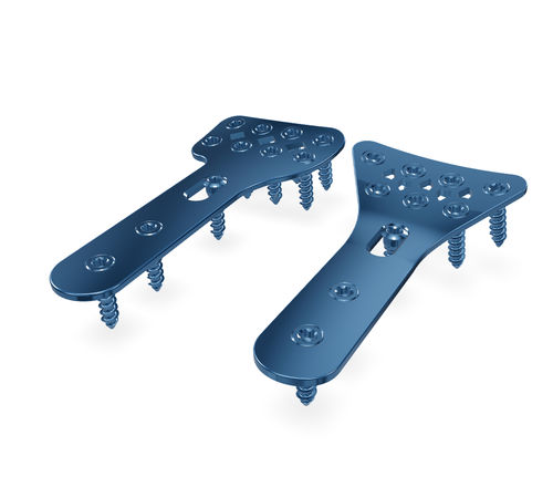 Radius compression plate - RSS system - Astrolabe - distal / dorsal / palmar