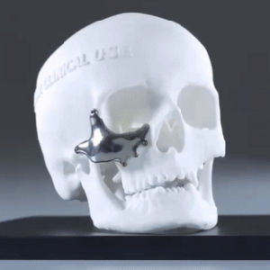 Custom-made periorbital implant - Ortho Baltic
