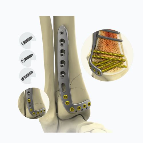 Tibia compression plate - 10132 series - Zimed Medical - distal / anterolateral / locking