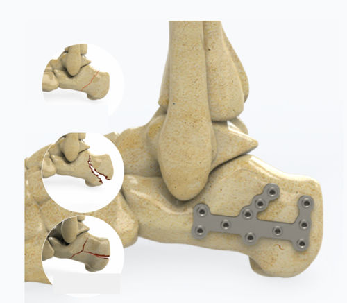 Calcaneus compression plate - 1602 series - Zimed Medical - locking / metallic