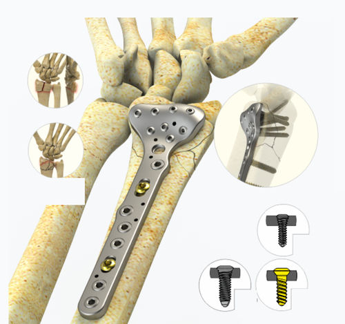 Radius compression plate - 9922 series - Zimed Medical - distal / locking / metallic
