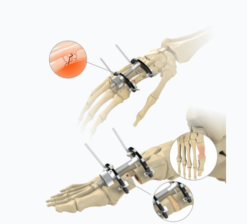 Metacarpophalangeal joint external fixation system - 5784-0000	 - Zimed Medical - metatarsophalangeal joint / hybrid / adult