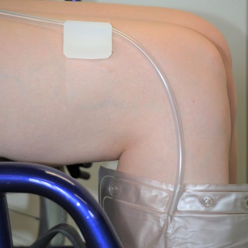 Adhesive catheter fixation - 8700350 - Transatlantic Handelsgesellschaft Stolpe