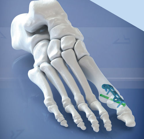 Hallux valgus arthrodesis plate - 400108 series - AGOMED Medizin ...