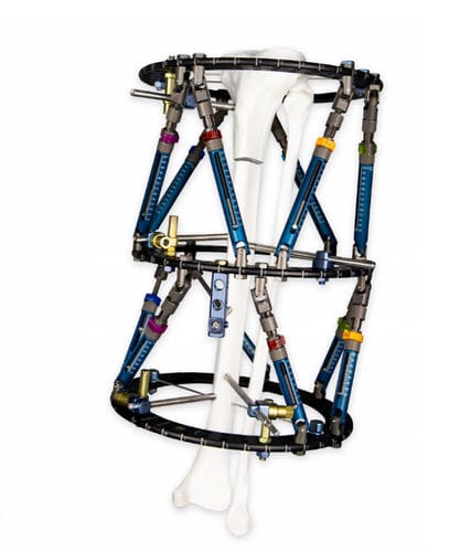 Tibia external fixation system - Smart Correction® - WishBone Medical ...