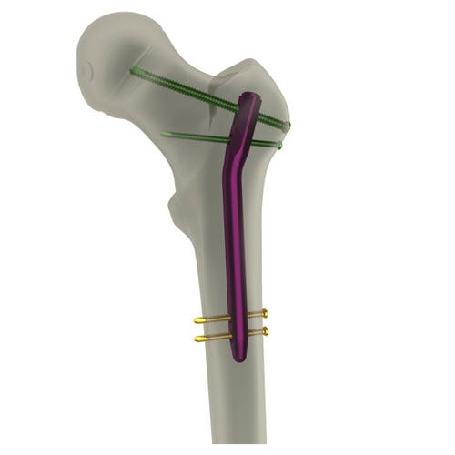 Femoral intramedullary nail - PediFIN® - WishBone Medical - proximal fixation / pediatric