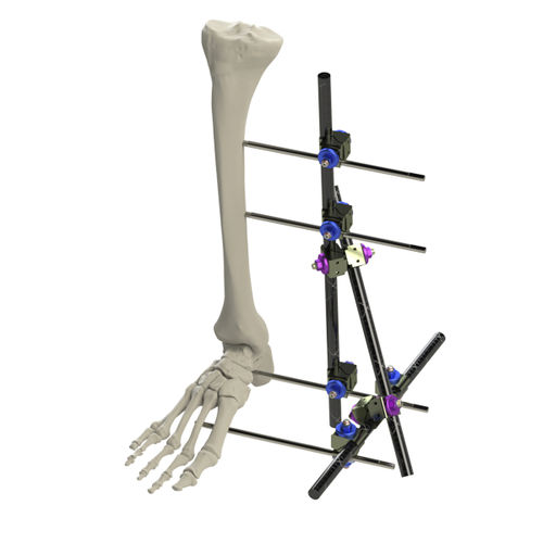 Extra-Caliber (carbon fiber) Radiolucent Tibia/Ankle System