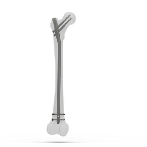 Femoral intramedullary nail - FN2 series - TASARIMMED - proximal fixation / distal fixation / right