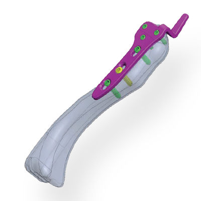 Acromioclavicular joint osteotomy plate - Invamed - proximal / locking / metallic