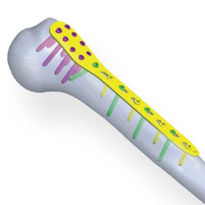 Humerus compression plate - Invamed - proximal / locking / metallic