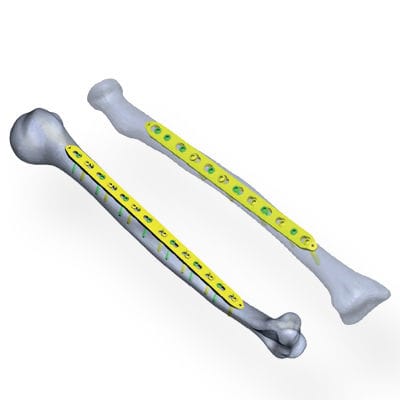 Radius compression plate - Invamed - ulna / humerus / mid-shaft
