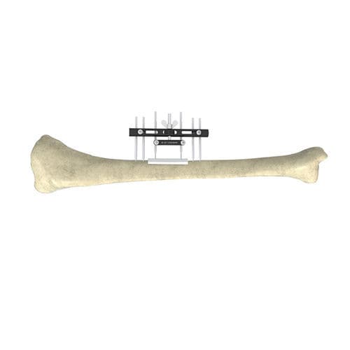 Tibia external fixation system - Wuxi Betta Medical Technology - tubular / adult