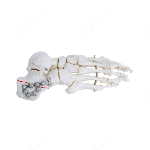 Calcaneus compression plate - T3010 - Kangli Medical - non-locking / titanium
