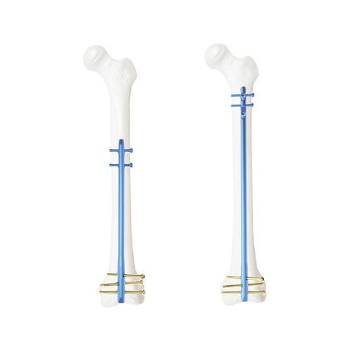 Femoral intramedullary nail - QML - Kangli Medical - titanium