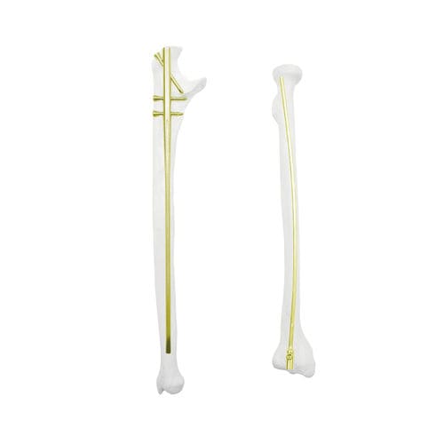 Radius intramedullary nail - QML - Kangli Medical - ulna / proximal ...