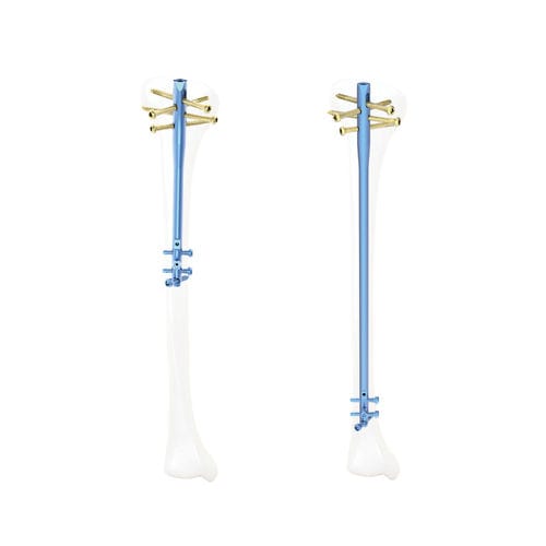 Tibial intramedullary nail - QML - Kangli Medical - titanium