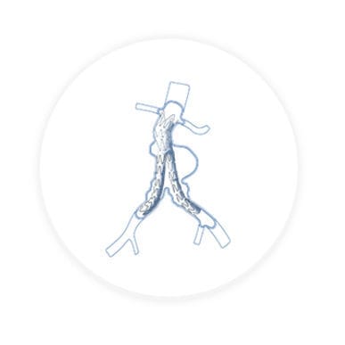 Iliac artery stent graft - Hercules™ - Endovastec - nitinol / polyethylene
