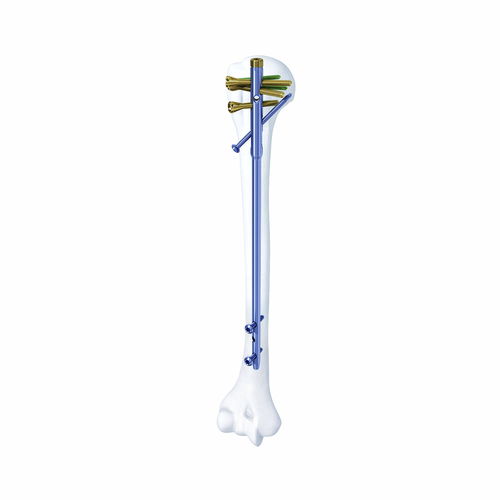 Humeral intramedullary nail - SHGK - Chongqing FWS Medical Device - proximal fixation / mid-shaft fixation / metallic