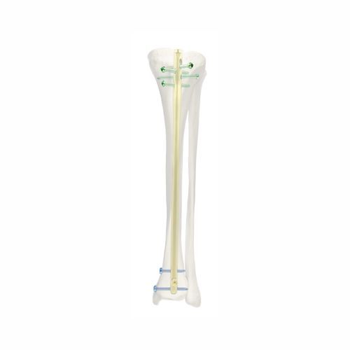Tibial intramedullary nail - SJGK - Chongqing FWS Medical Device