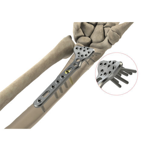 Radius compression plate - AS.W.011 - Ases Orthopedics - distal / locking / non-locking