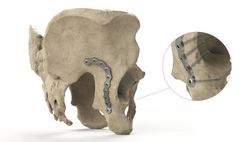 Pelvis compression plate - Ases Orthopedics - posteroproximal