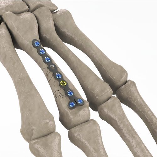 Metacarpal joint compression plate - 1T112-100102023 - Ases Orthopedics - locking
