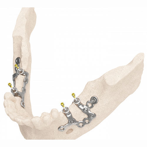 Dental surgical guide - IUXTA 3D - Biotec - BTK