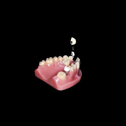 Titanium implant abutment - Shenzhen Alcadent Co.Ltd Alcadent Dental Laboratory - zirconia / PEEK / internal