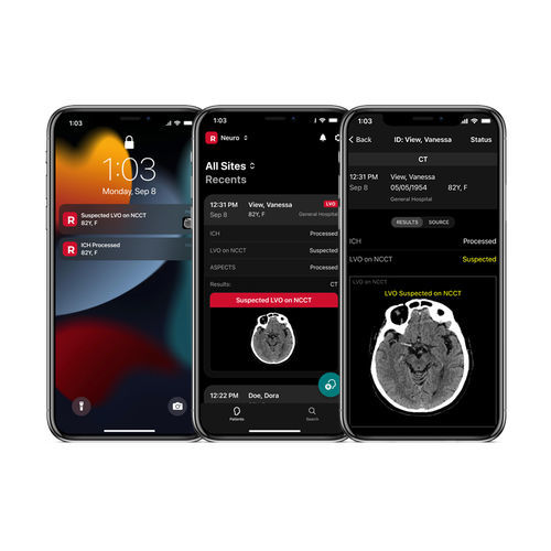 Stroke diagnosis mobile application NCCT RapidAI medical / CT