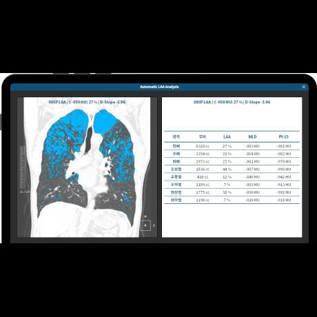 Analysis software - LCS PLUS - Coreline - for lung cancer screening / medical / CT