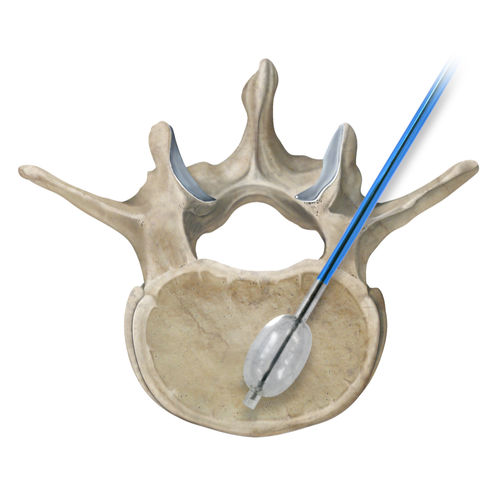 Needle spine augmentation system - Osteo-Site® - IZI Medical - balloon ...