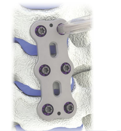 Cervical vertebra arthrodesis plate - HERO® - HumanTech Dental - 2 levels