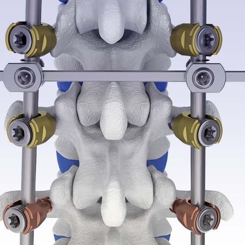 Thoraco-lumbar osteosynthesis unit - VENUS® - HumanTech Dental - posterior / adult