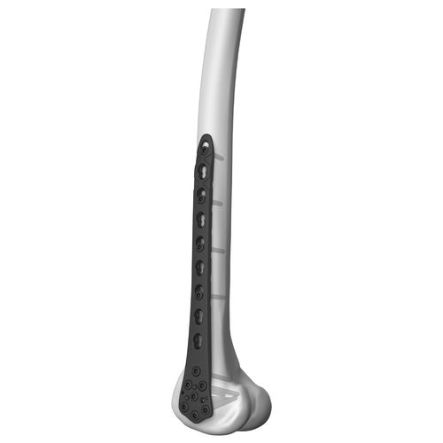 Femur compression plate - 301014 series - Boneunion Medical - distal / lateral / locking