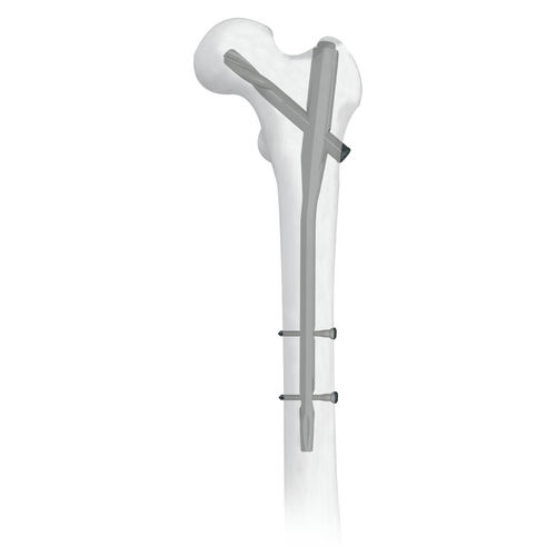Femoral intramedullary nail - 30500 series - Boneunion Medical - proximal fixation / titanium