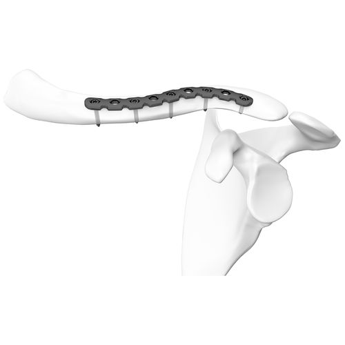 Clavicle compression plate - 301249 series - Boneunion Medical - distal / locking / titanium
