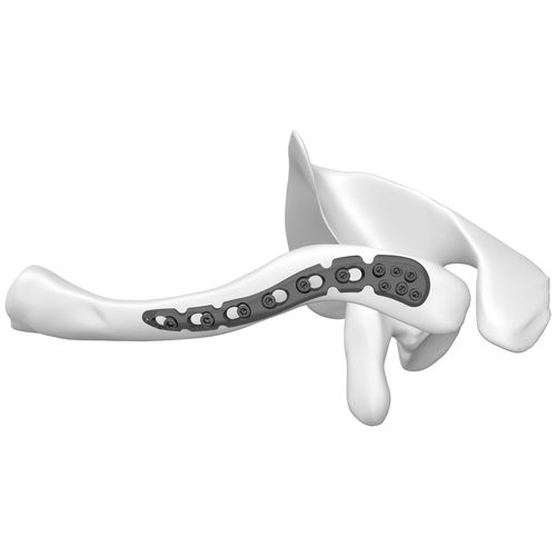 Clavicle compression plate - 301055 series - Boneunion Medical - distal / locking / titanium