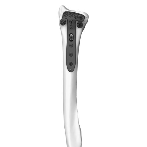 Radius compression plate - 30104 series - Boneunion Medical - distal / locking / titanium