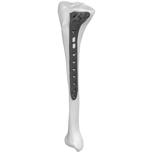 Tibia compression plate - 301022 series - Boneunion Medical - proximal / lateral / locking