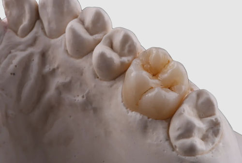Zirconia dental material - Venus - Orodent srl - for dental
