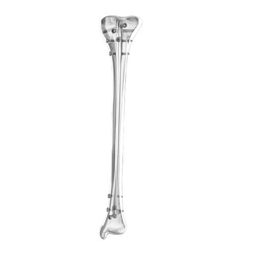 Tibial intramedullary nail - Aplus Biotechnology - proximal fixation / distal fixation / metallic