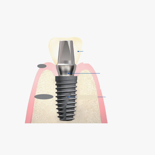Titanium implant abutment - Snucone Co.,Ltd - internal / straight / cemented